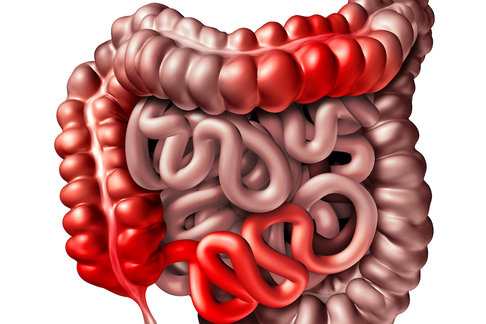 Study into the causes of Crohn’s disease hits major milestone