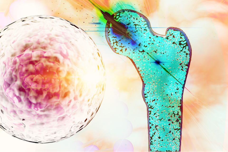 MaaT Pharma Announces First Patient Dosed in Phase 2 Clinical Trial of Lead Product MaaT013, a First-in-Class Biotherapeutic to Treat Acute GvHD