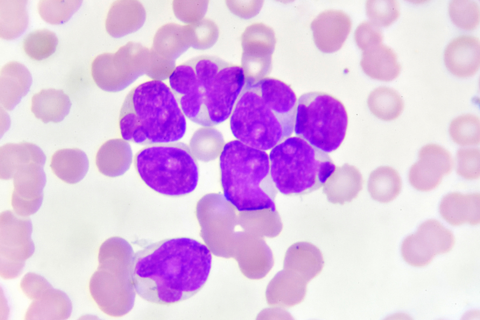 MaaT Pharma Presents Positive Phase 1b/2a Study Results in Acute Myeloid Leukemia Patients