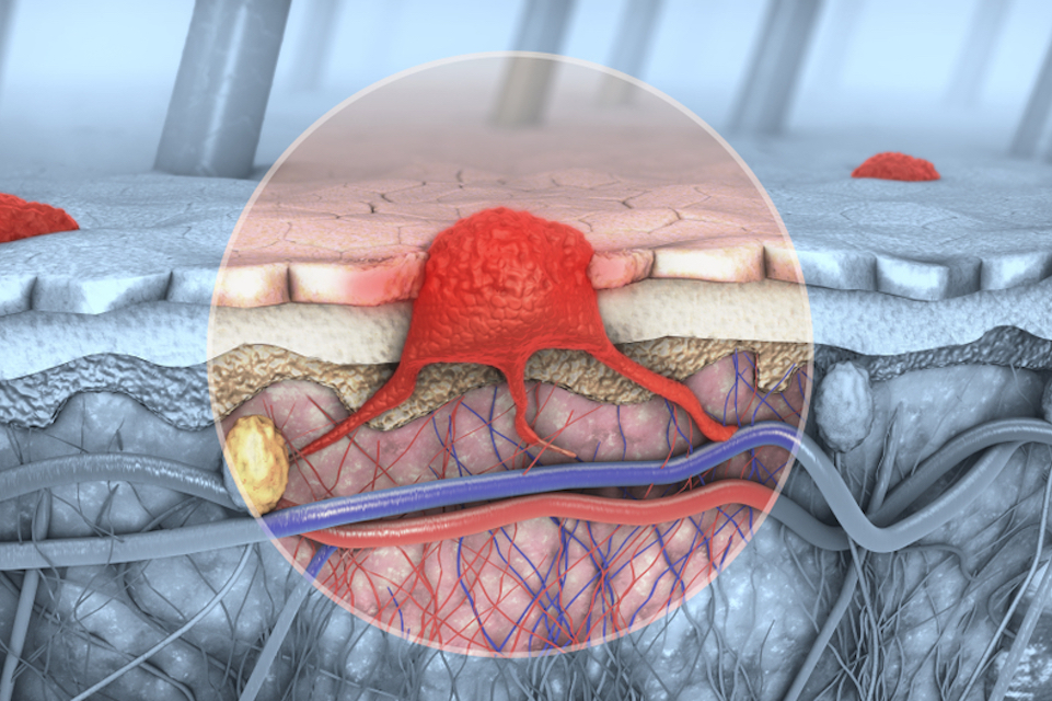Evelo Announces Dosing of First Patient in Phase 2a Clinical Trial in Patients with Metastatic Melanoma