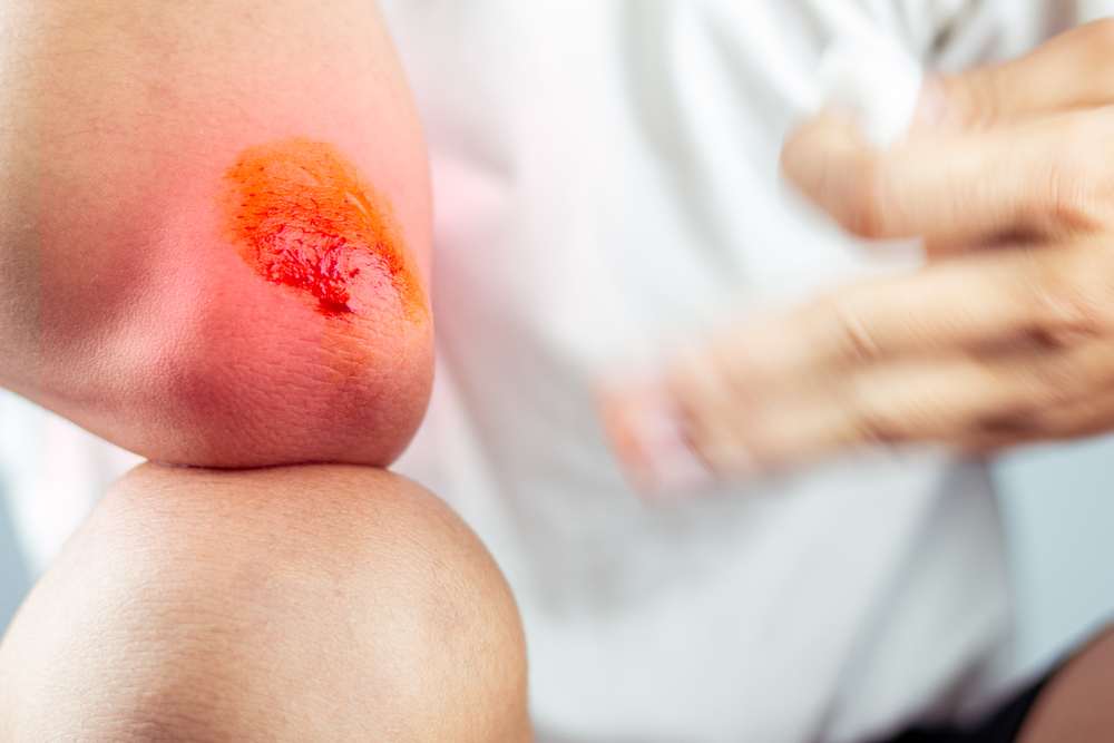 Swedish MPA approves First in Human trial of Ilya Pharma’s first-in-class ILP100 topical wound care therapy