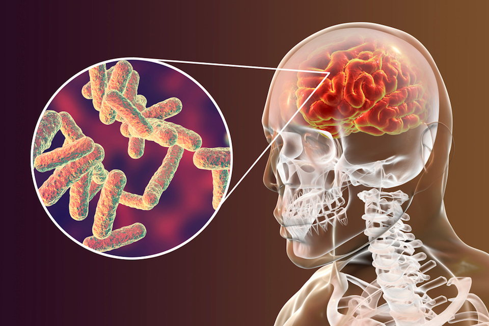 Fecal transplantation to treat patients with Parkinson’s disease: Hope or hype?