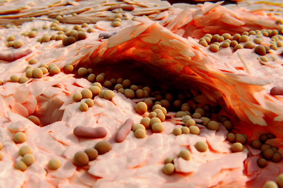 EU-Funding: Micreos Awarded €2.5 Million for Breakthrough for Skin Problems Including Acne and Eczema