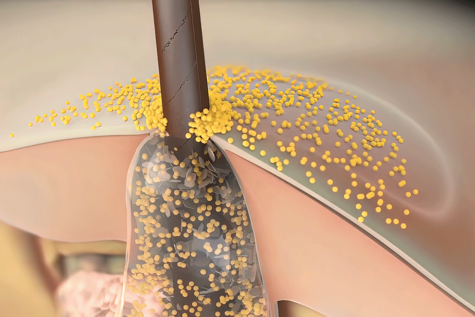 Key patent issued on Eligo’s gene editing breakthroughs applied to skin disorders