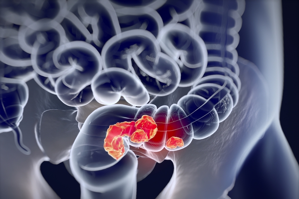 Colorectal cancer surgery: Gut microbiota helps healing