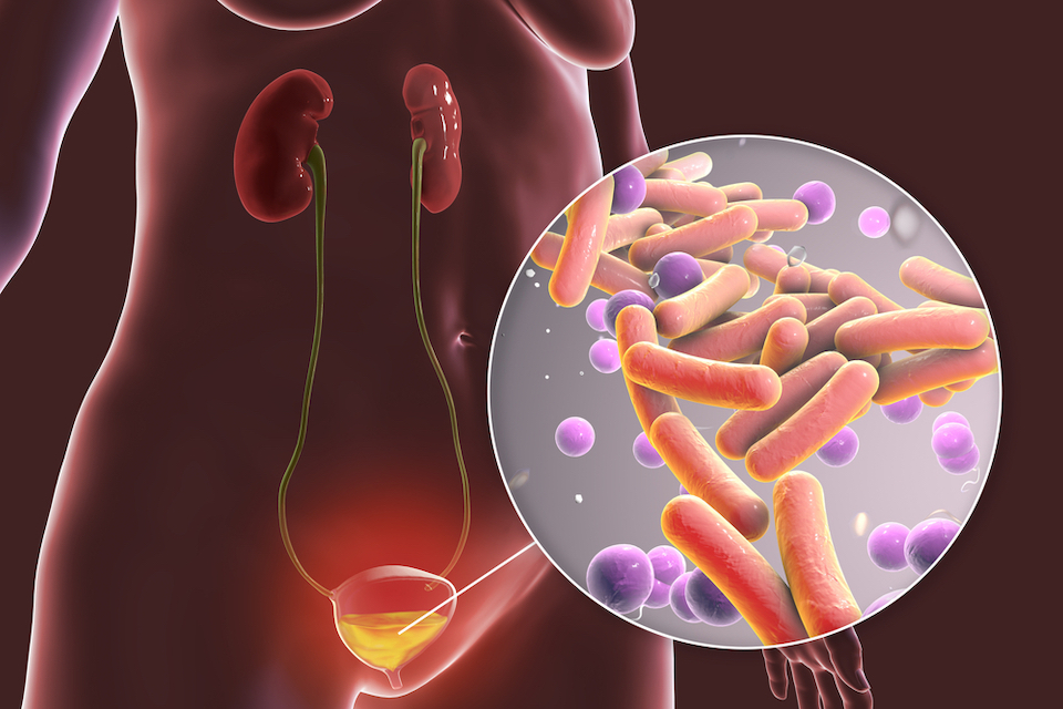 Treating bladder infections with viruses