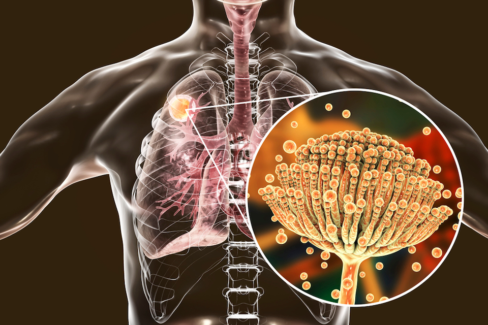 A fungus gets comfortable: Aspergillus fumigatus adapts to life in humans and shapes their lung microbiome