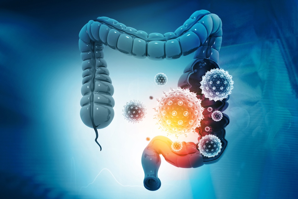 Bacteria subtype linked to growth in up to 50% of human colorectal cancers