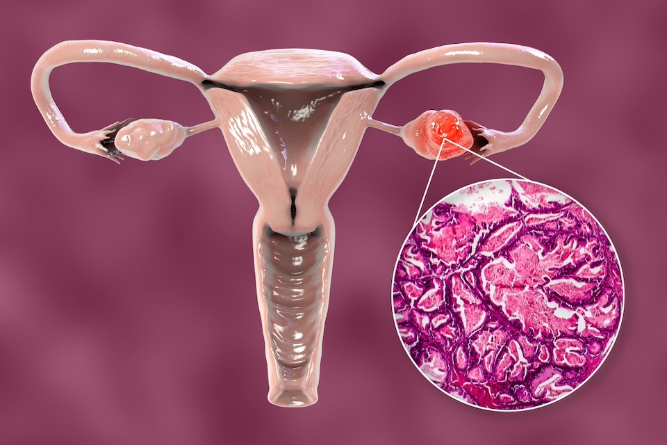 Mayo scientists developing at-home swab tests for endometrial, ovarian cancer