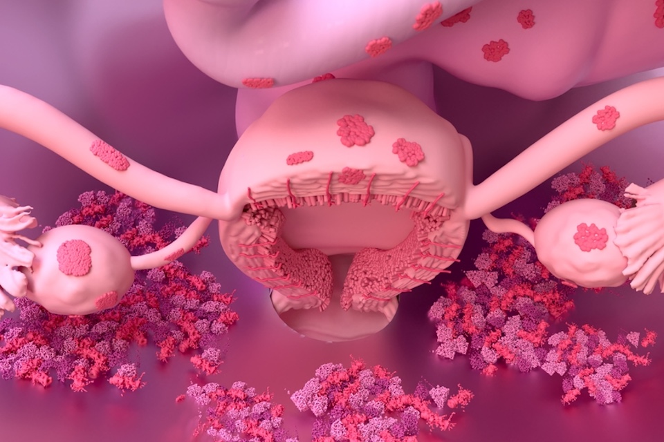 A potential non-invasive stool test and novel therapy for endometriosis
