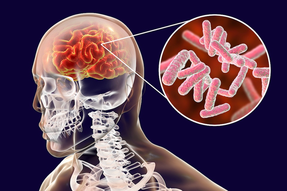 Traces of bacteria inside brain tumors may affect tumor behavior