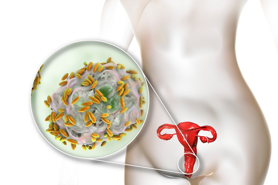 LACTIN-V: A Promising Live Biotherapeutic for Recurrent Bacterial Vaginosis